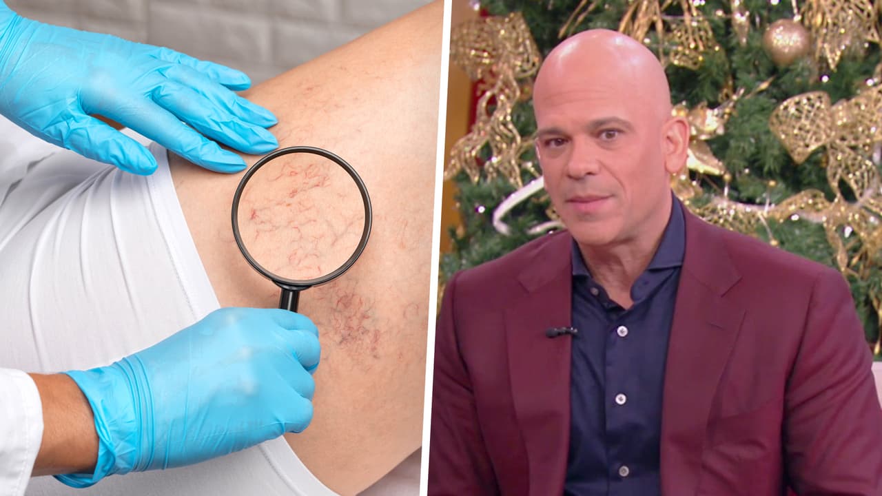 ¿Qué es la insuficiencia venosa? Dr. Juan lo explica y cómo tratar los problemas de circulación