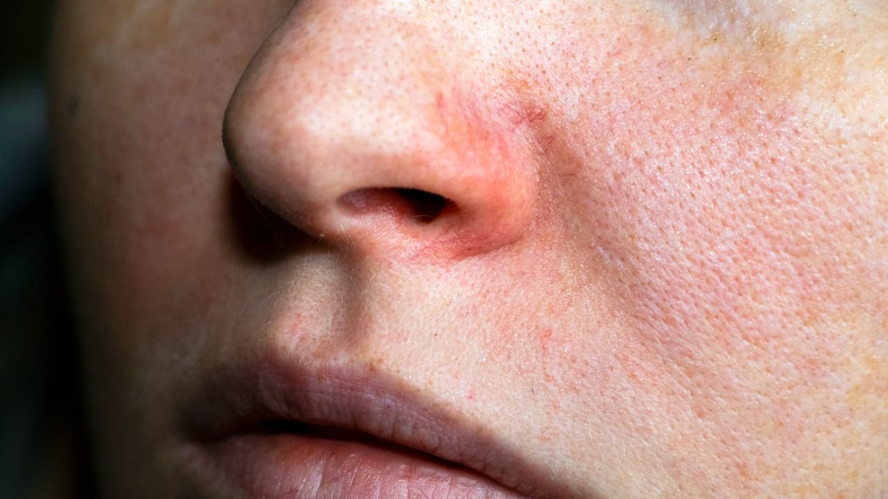 3 máscaras naturais para fazer em casa e fechar os poros abertos da pele