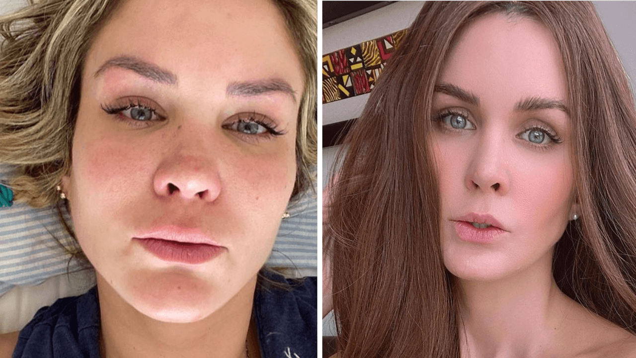 Tras un año de malos diagnósticos, Verónica Montes está bajo tratamiento por un tumor en la frente