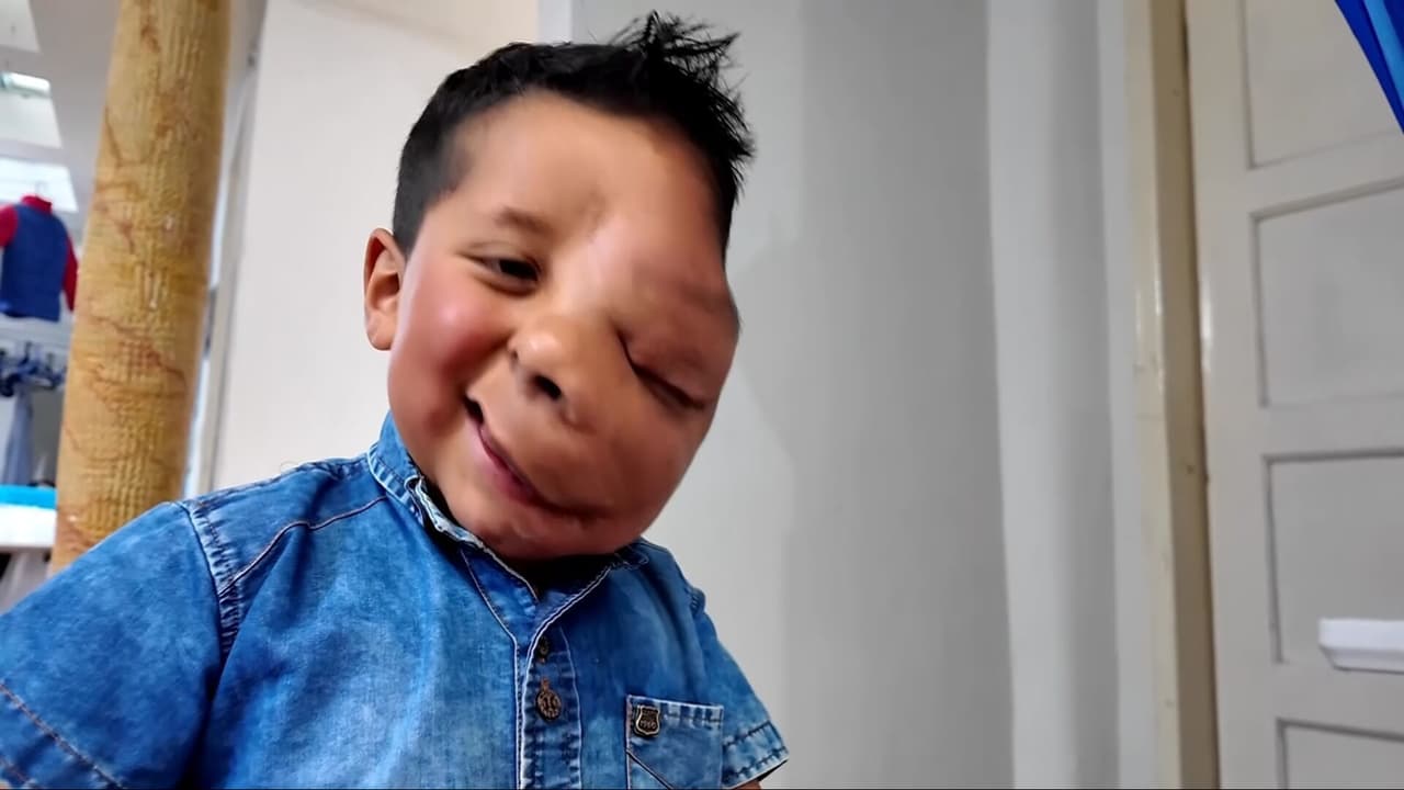 Andrés Felipe, de cinco años, padece una compleja neurofibromatosis.