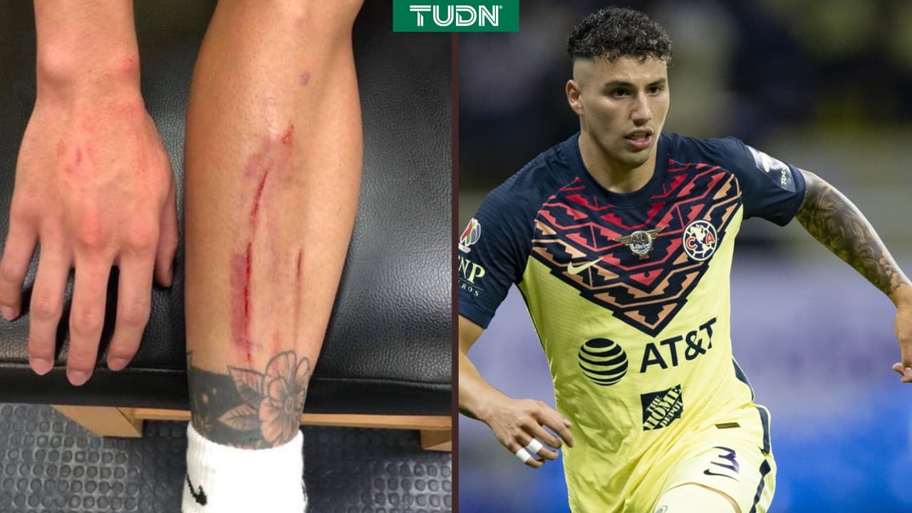 Sánchez muestra las 'huellas de la batalla' por pisotón de Chicote