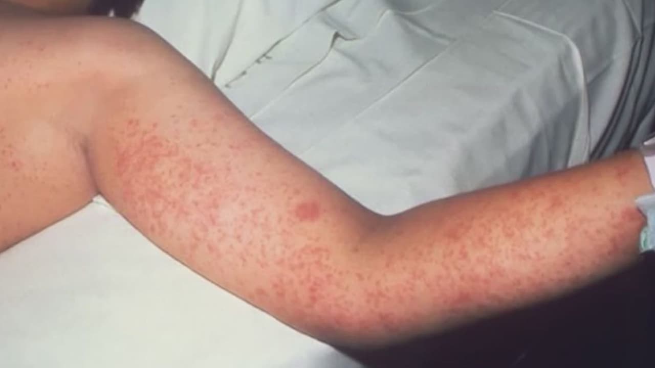 Cómo el brote de sarampión en EEUU se extendió a México (y qué hace el país para contenerlo)