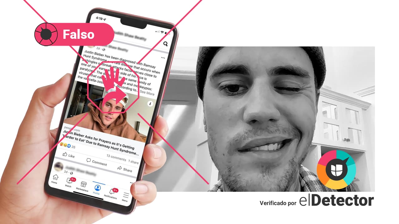 El síndrome que le provocó parálisis facial a Justin Bieber NO es viruela del mono 