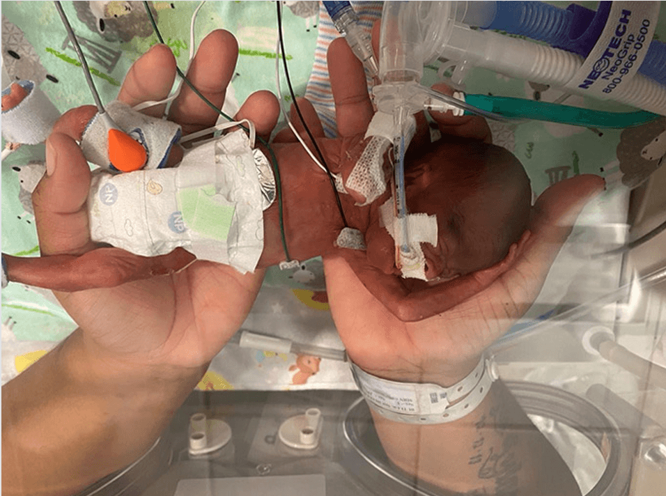 No tenía probabilidades de vivir, pero lo logró: este es el bebé más prematuro del mundo