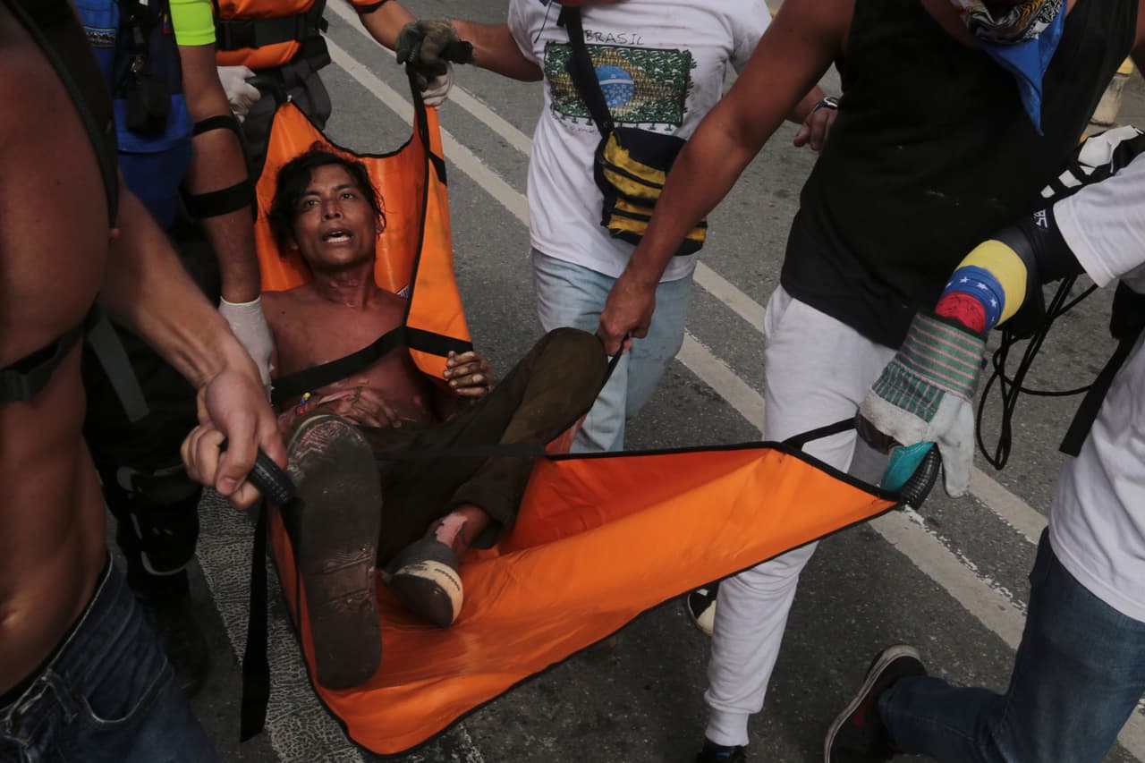 The young man was taken to a local hospital along with another burn victim. Some 71 protesters were treated at one hospital in the Chacao municipality on Wednesday, 57 with fractures and blows from tear gas canisters and other objects, two with burns, 11 with breathing difficulties. May 3, 2017.