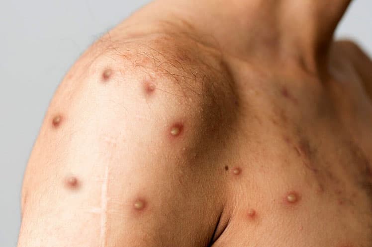 Viruela del mono pega con fuerza a comunidad latina gay en Santa Clara