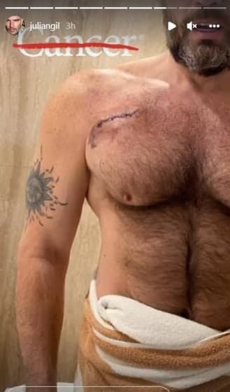 “Entonces me empezó a revisar. Lunares, manchitas que yo traía, y tenía una aquí [debajo del hombro derecho] desde hace mucho tiempo”, Gil en entrevista para el programa Hoy.
<br>