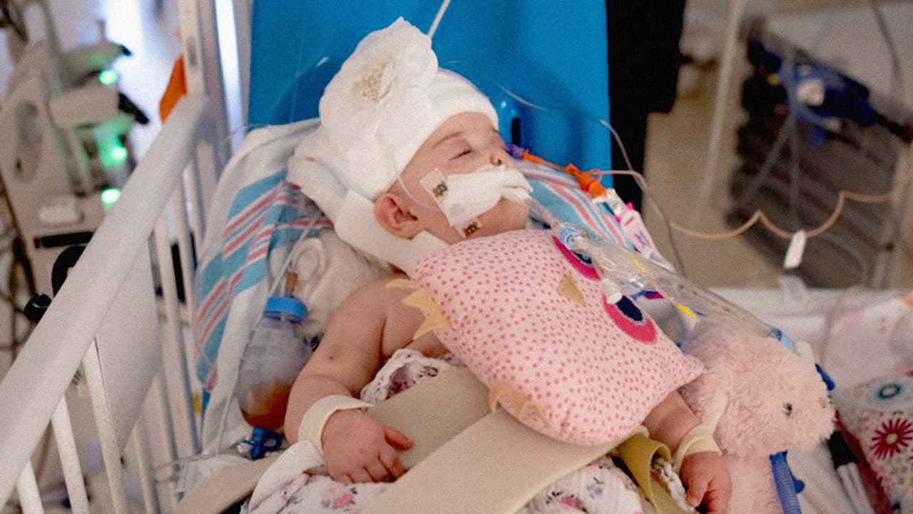 Abigail Bachinskiy se recupera después de la cirugía en la que la separaron de su hermana, con la que había nacido unida por la cabeza.