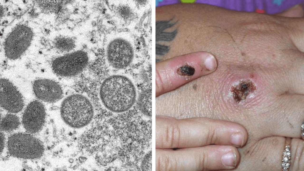 Los síntomas de la 
<a href="https://www.univision.com/local/houston-kxln/este-es-el-panorama-en-el-condado-de-harris-con-la-viruela-del-mono-y-la-disponibilidad-de-vacunas-video" target="_blank">viruela del mono</a> son fiebre, dolor de cabeza, dolores musculares y de espalda, inflamación de los ganglios linfáticos, escalofríos, agotamiento y lesiones en la piel que parecen ampollas y se van haciendo más grandes.