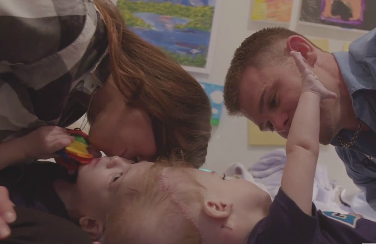 Separados con éxito siameses de Illinois unidos por la cabeza; uno está en condición crítica 