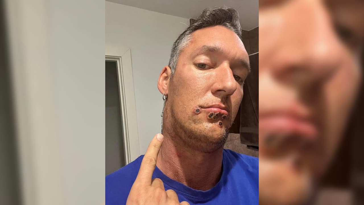 “Todos los síntomas de la viruela del mono que tenía como los e
<b>scalofríos, fiebre, dolores de cabeza</b>, de todo eso ya no tengo nada, lo único que tengo son las ampollas en mi cara ahora”, comentó.