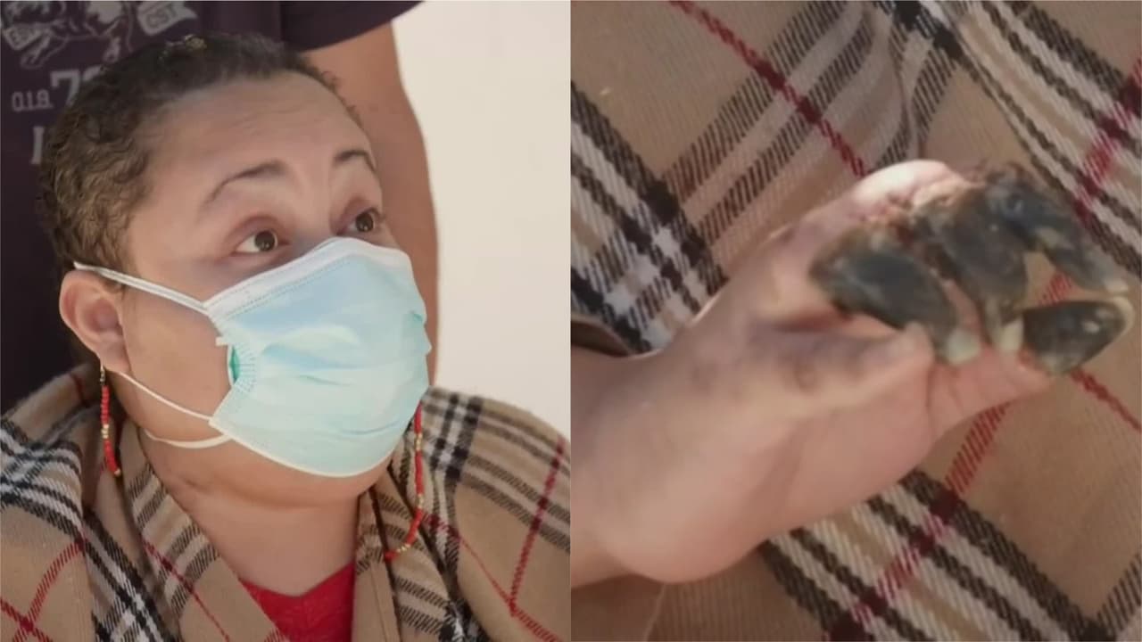 <b>"Mis dedos se van a autoamputar": mujer que sufrió complicaciones por el covid-19</b>
<br>
<br>Rosa Felipe no pudo contener las lágrimas al salir de un hospital en Florida luego de nueves meses internada luchando contra el coronavirus. Ella es técnica en enfermería y se contagió atendiendo a pacientes con el virus. Ahora continúa en un proceso de recuperación, en silla de ruedas y aprendiendo a caminar pues no tiene movilidad. Asegura que sus dedos se "autoamputarán".