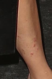 En las fotos que le tomaron, se ve cómo le afecta la psoriasis, una enfermedad que intenta poner bajo control desde que tenía 30 años. 
<br>