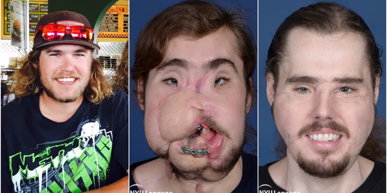 Un disparo le desfiguró el rostro cuando intentó suicidarse, ahora una increíble cirugía lo restauró casi a la perfección