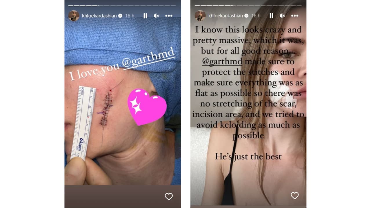 Khloé Kardashian lucía así tras la operación en la que le extirparon el cáncer de piel.