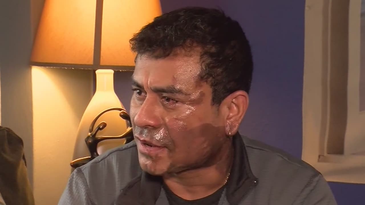 'Vienes aquí ilegalmente': Palabras del atacante hacia la víctima que sufre quemaduras de ácido en la cara