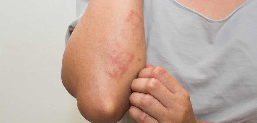 Universidad de Temple investiga combinación de medicamentos para tratar la sarcoidosis
