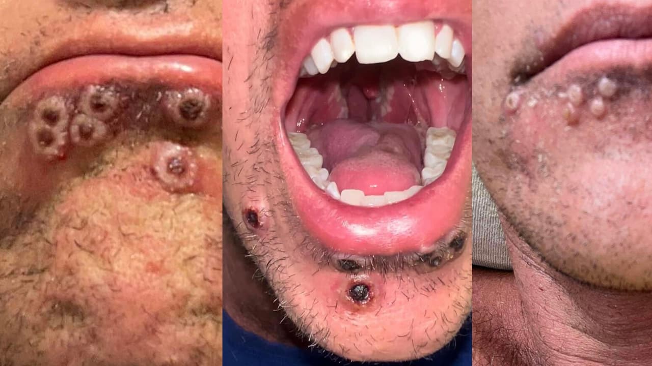 Viruela del mono ahora será llamada MPX por las autoridades de salud de California para evitar discriminación