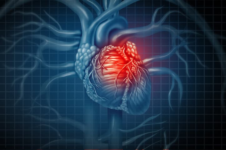 <b>¿Qué es la myocarditis? </b>
<br>Se refiere a la inflamación del músculo cardíaco y es causado por una variedad de condiciones infecciosas y no infecciosas.
