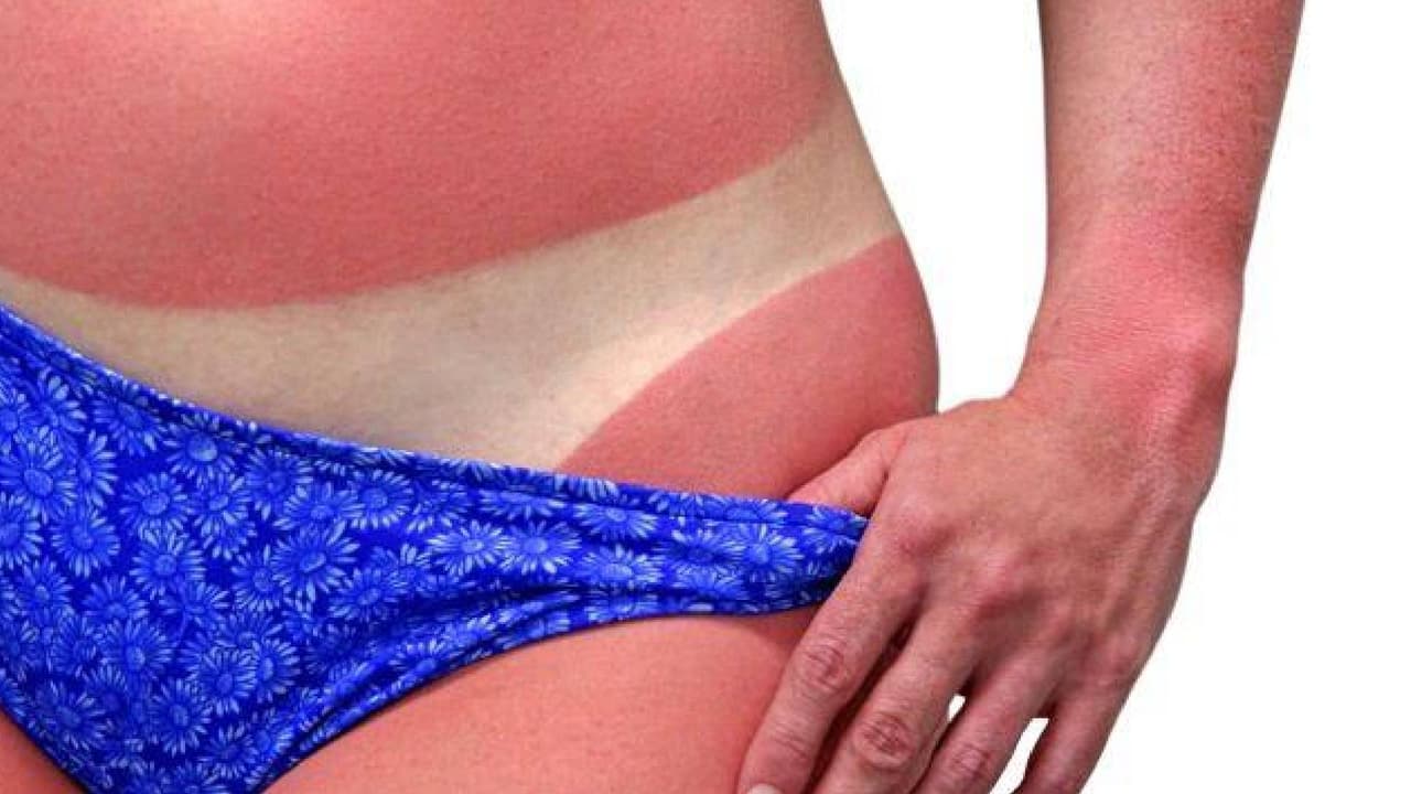 Nunca trates las quemaduras solares con productos de “-caína” (como la benzocaína), ya que pueden irritar la piel o causar una reacción alérgica. Considera 
<b>tomar aspirina o ibuprofeno</b> para ayudar a reducir la hinchazón, el enrojecimiento y la incomodidad.