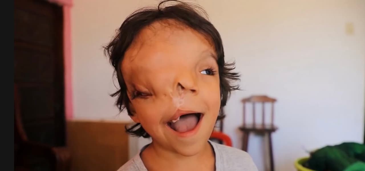 A pesar de que los doctores no le auguraron mucho tiempo en este mundo, el amor y cuidados de sus padres 
<b>han podido ayudarle a sobrevivir ya por 5 años</b>. 
<br>