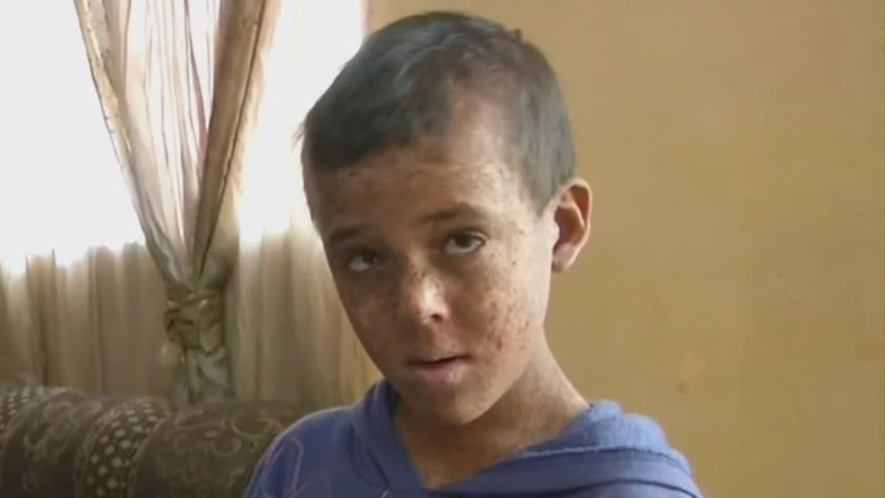 Extraña enfermedad condena a un niño mexicano a vivir en las sombras