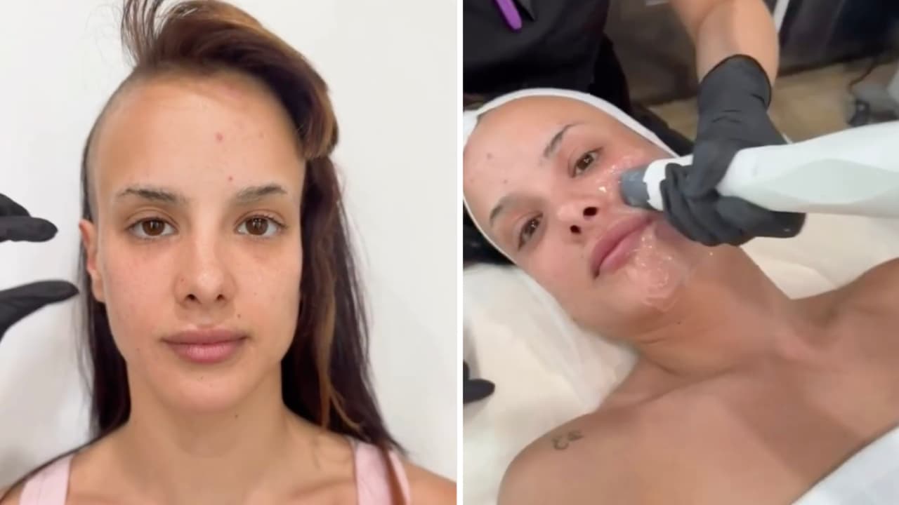 Gala Montes se somete a tratamiento estético tras raparse la cabeza y así se ve ahora: video