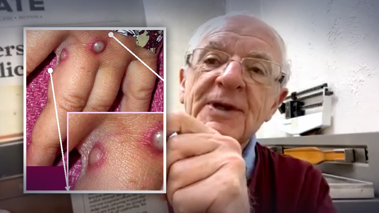 ¿Cómo se dio un falso positivo de la viruela del mono en un niño de Texas? Un experto nos explica