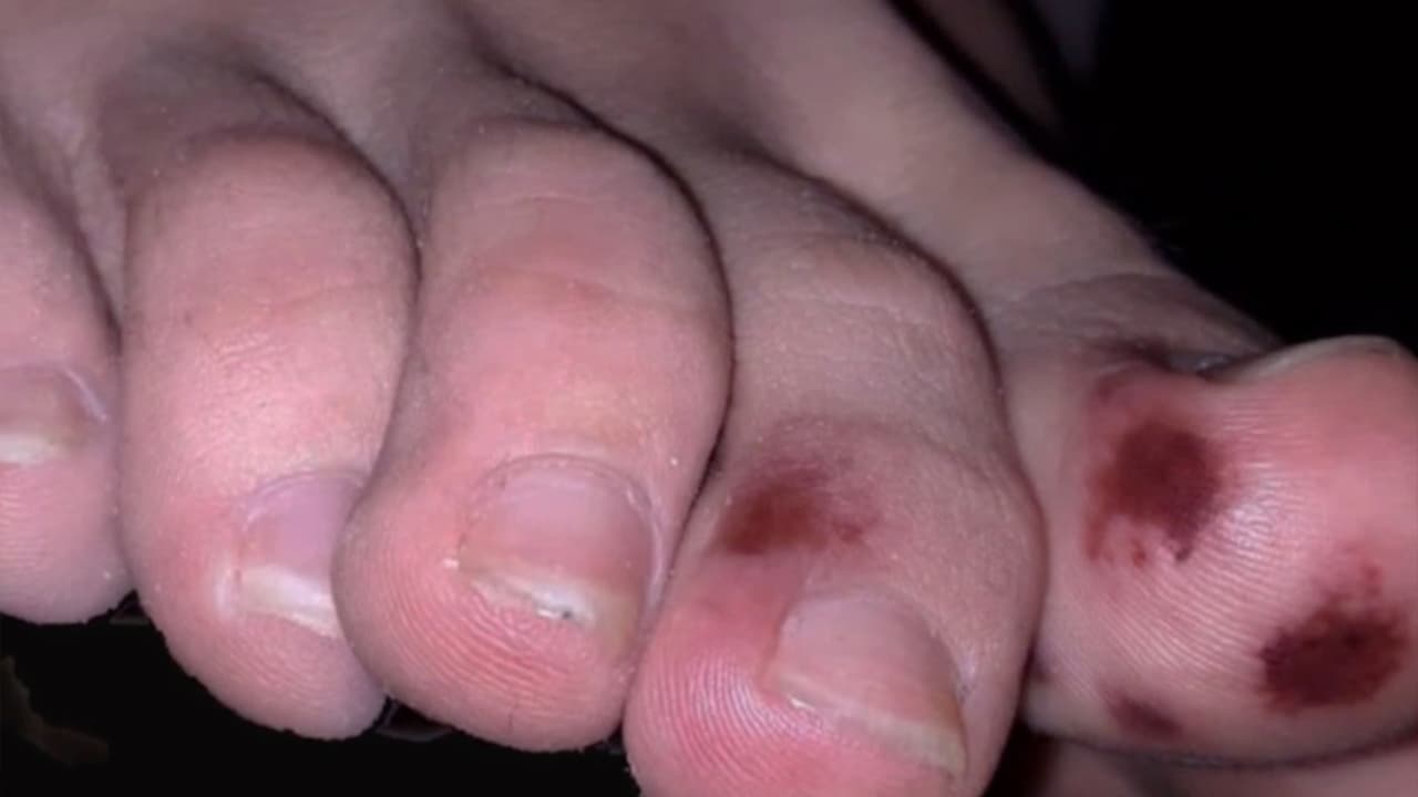 También puede ser una roncha o hasta un área negra donde no hay flujo de la sangre, es decir una trombosis.