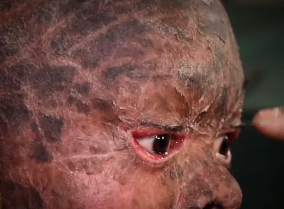 Al poco tiempo llegó el diagnóstico médico para el pequeño Henry Estévez: Ictiosis Vulgar, una enfermedad comúnmente conocida como piel de pescado que le ha dejado el cuerpo agrietado, lleno de escamas y los párpados al revés. 
<br>