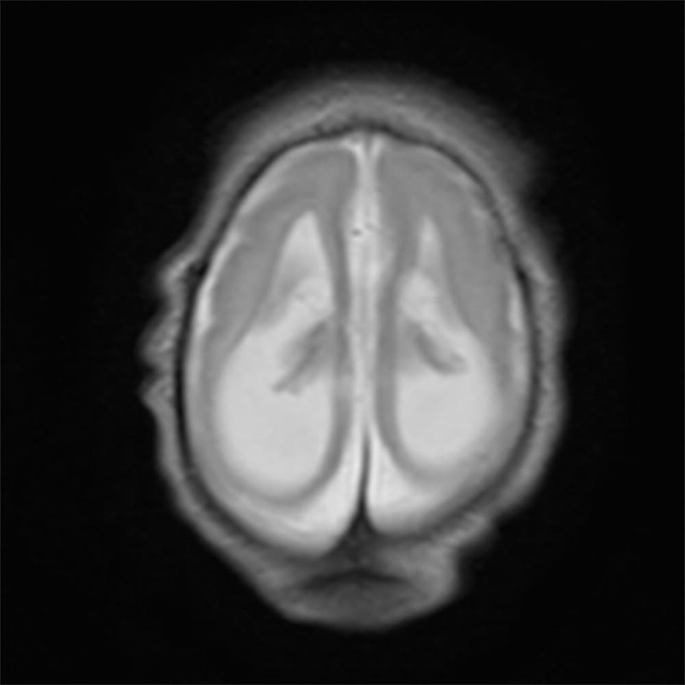 Estas imágenes tridimensionales fueron obtenidas una semana después de que los bebés nacieran.