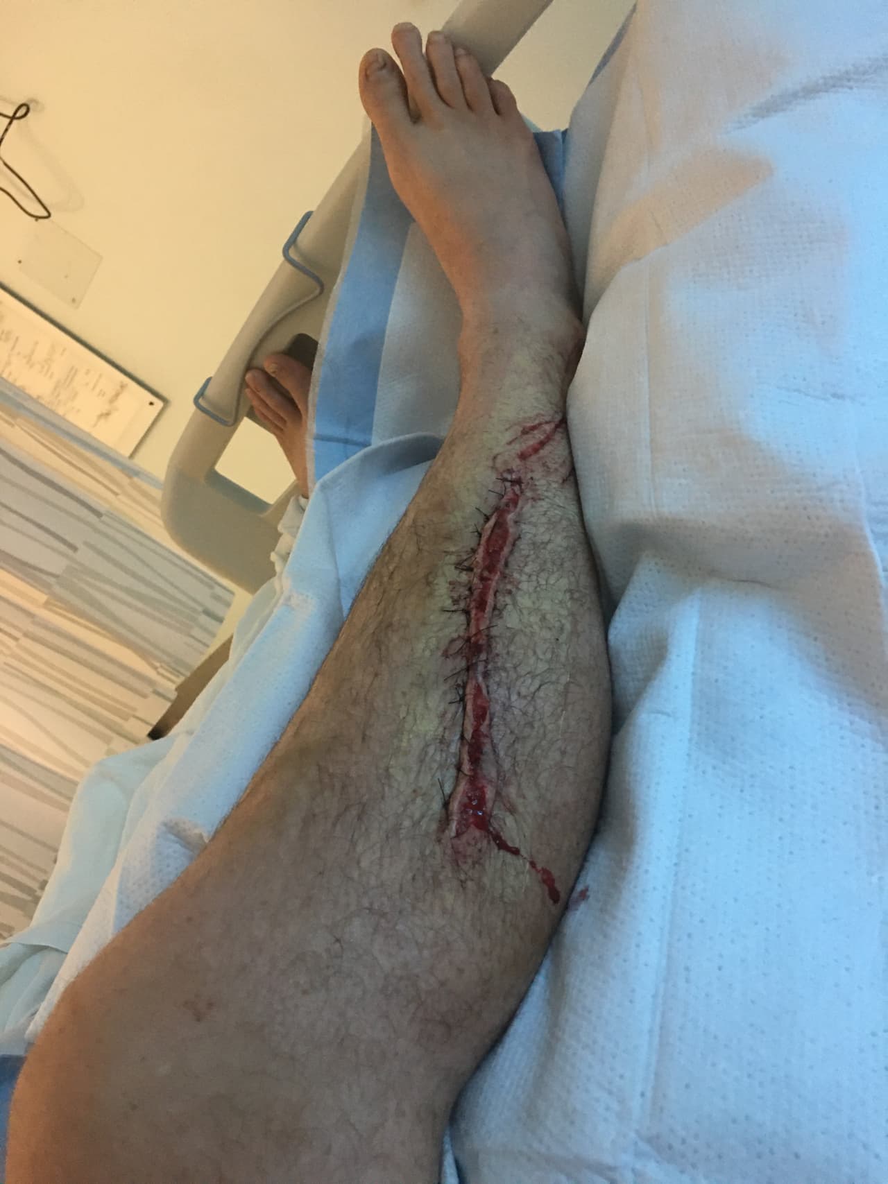 La herida midió más de 8 pulgadas. 
<br>