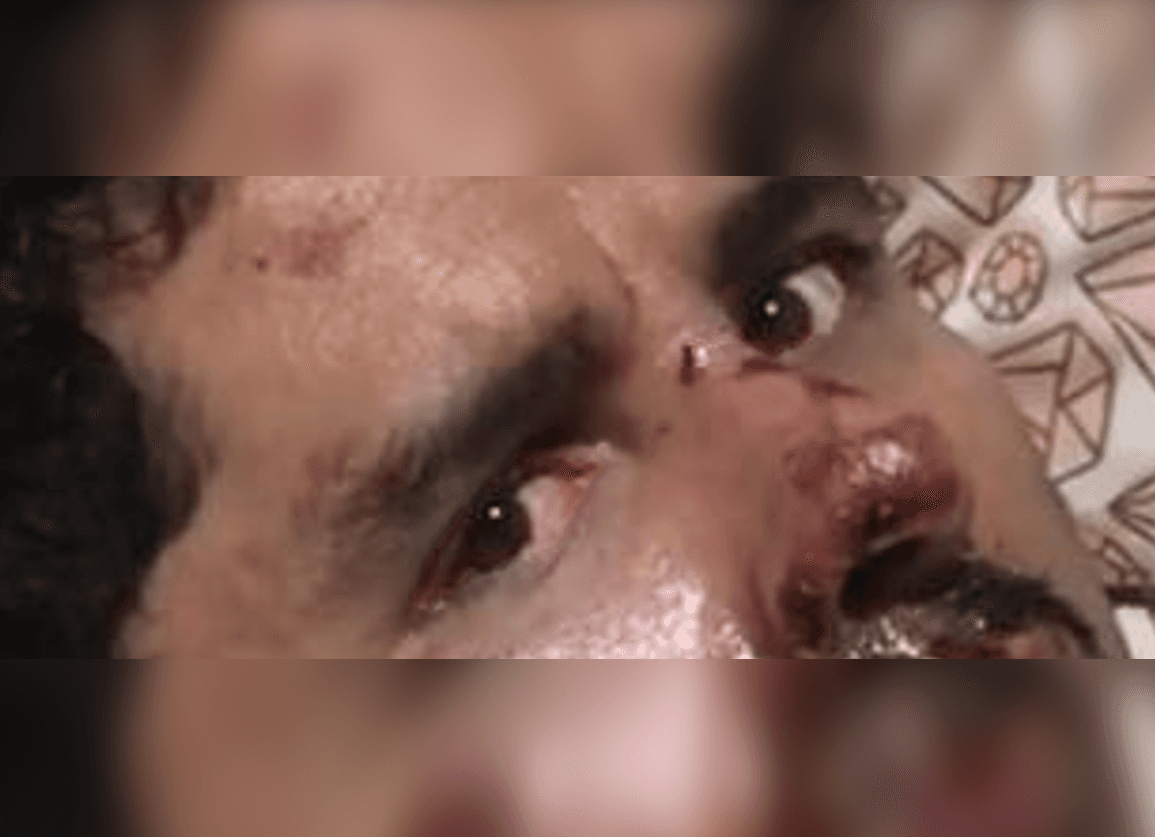 Su mirada lo dice todo: Larry Hernández muestra cómo tiene el rostro a un mes de su accidente