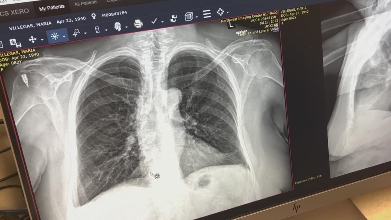 El cáncer de pulmón presenta una de las tasas más altas de muerte