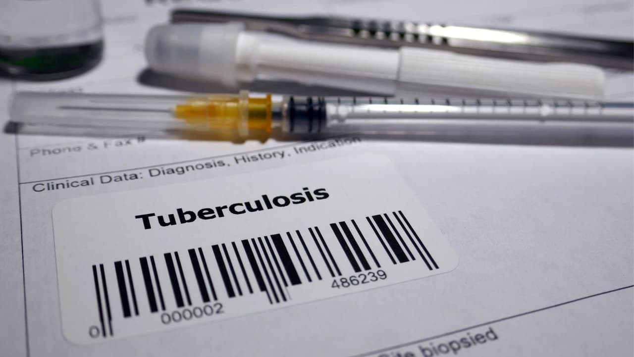  Alerta de salud: Confirman caso positivo de tuberculosis en una escuela y esto debes saber  