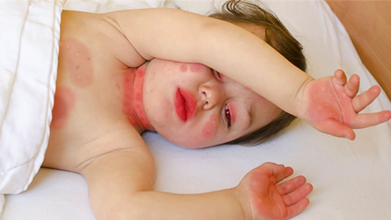 Estudio muestra qué ocurre en el cuerpo de niños con Síndrome Inflamatorio causado por el coronavirus