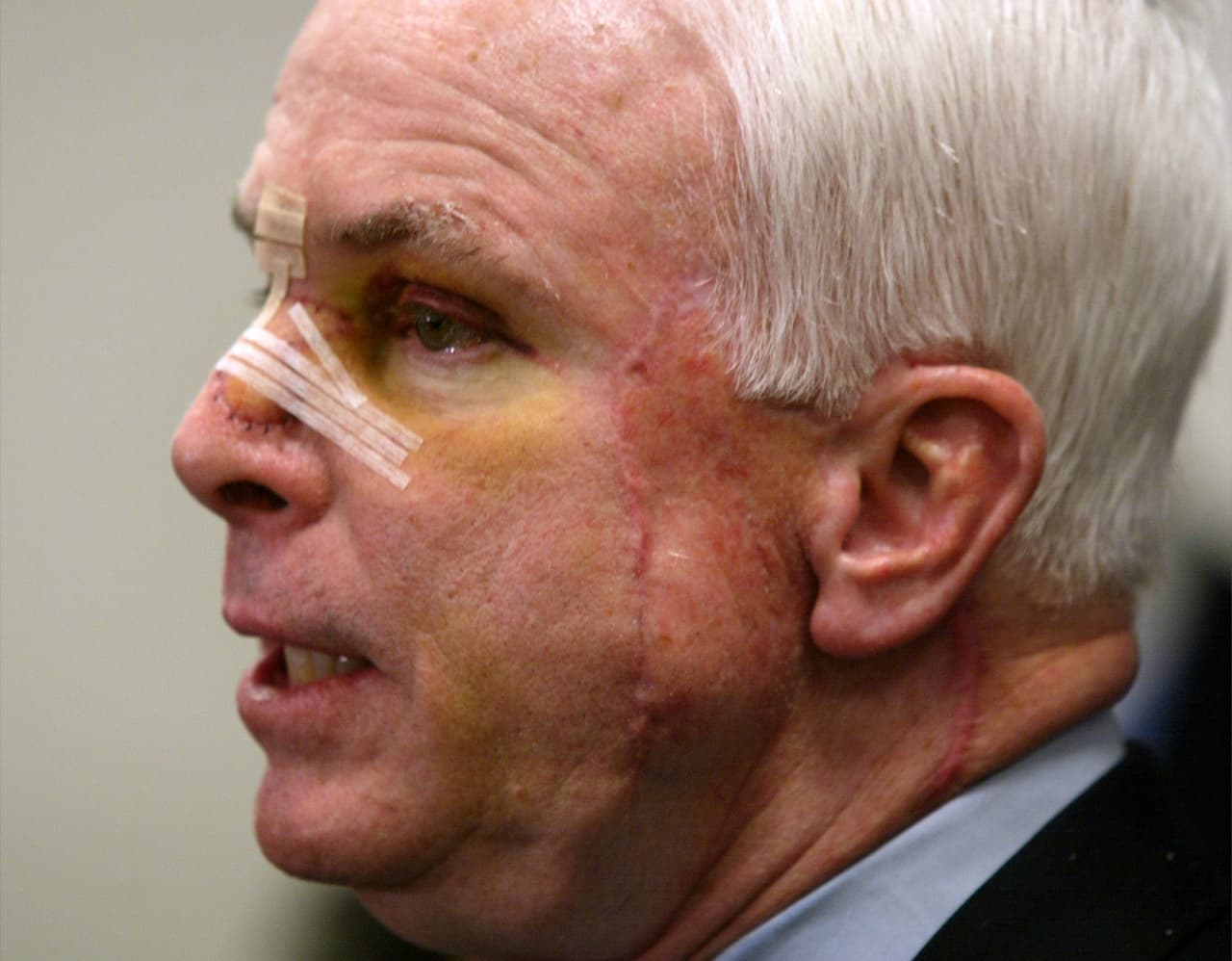Años antes de ser diagnosticado con cáncer cerebral, John McCain sufrió de cáncer de piel (melanoma). En la imagen se le observa la herida en la nariz, tras someterse a una cirugía en febrero de 2002.