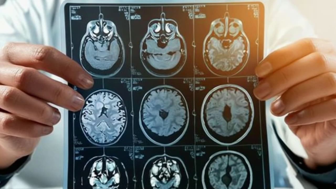 ¿Existe un tipo de demencia ligada a cambios de personalidad?