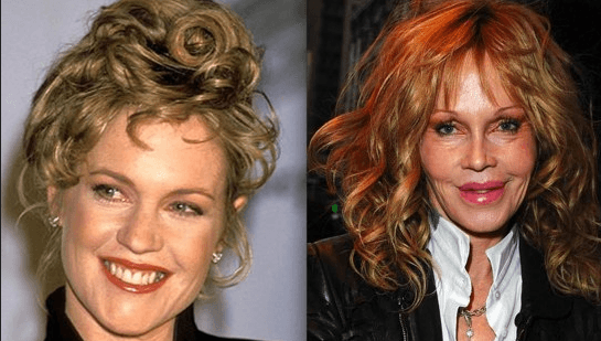 ¿Recuerdan que a fines de los 80's y mediados de los 90's, Melanie Griffith era uno de los rostros más lindos de Hollywood que conquistó con toda facilidad a Antonio Banderas? Hoy ya no sigue casada con el actor español ni ha podido retomar su carrera en el cine.