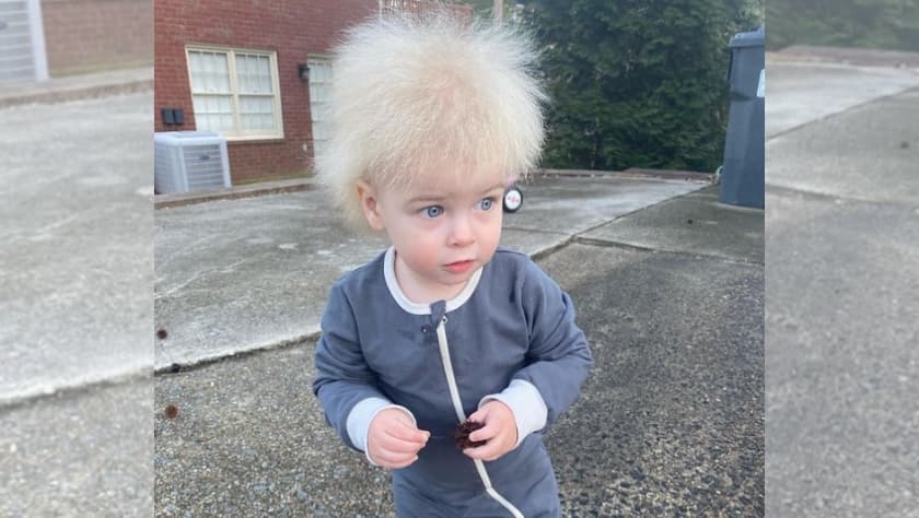 El extraño síndrome de los 'pelos parados' que tiene un bebé de 10 meses