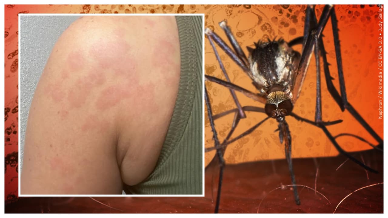 El Departamento de Salud de Florida reporta un caso de Dengue en Miami-Dade