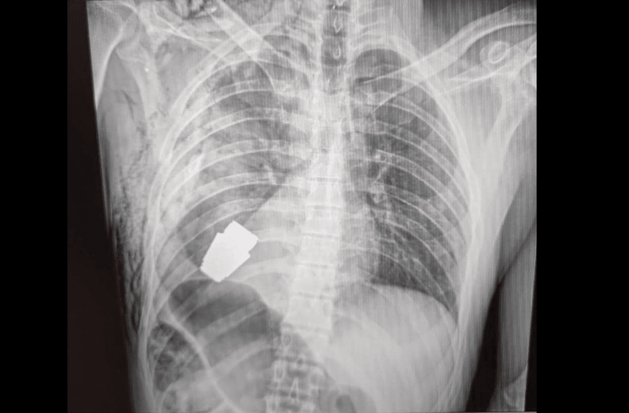 Esta granada sin detonar estaba a solo centímetros del corazón de un soldado ucraniano... y fue extraída con éxito
