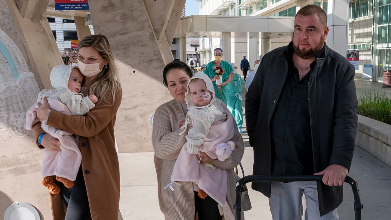 Se van a casa mellizas que anteriormente estaban unidas por la cabeza y recibieron cirugía en Sacramento