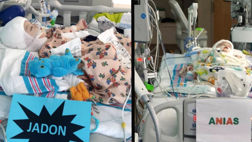 Los siameses Jadon y Anias se recuperan de la cirugía que los separó, pero es pronto para saber cómo les impactó