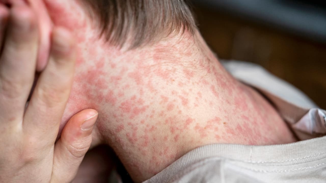 Alertan por posible exposición al sarampión en el aeropuerto de Newark.