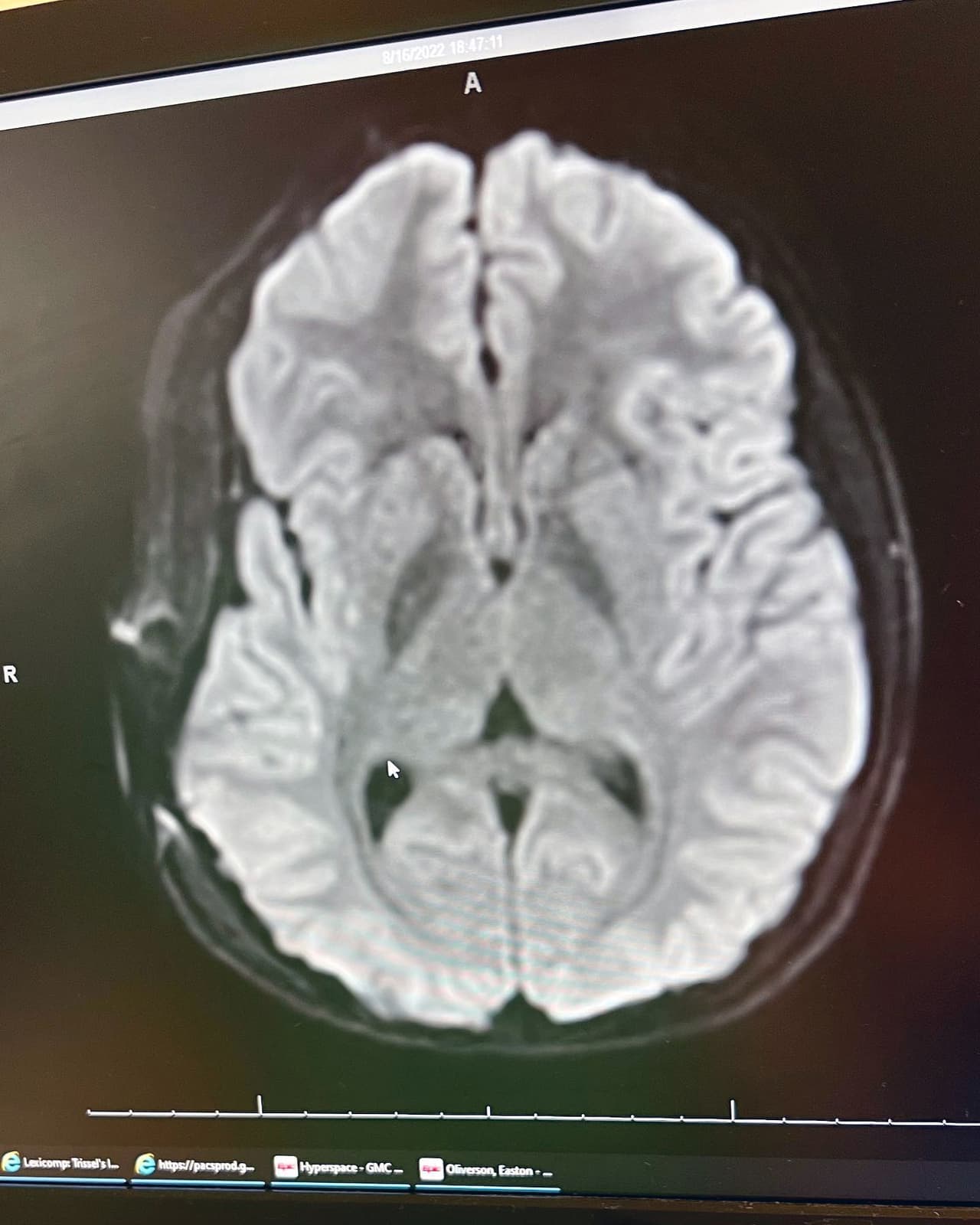 Horas antes de empezar la competencia, 
<a href="https://www.univision.com/local/salt-lake-city-kuth/easton-oliverson-sufrio-grave-lesion-caer-cama" target="_blank">Easton cayó desde lo alto de una litera mientras dormía</a>. Lo trasladaron por aire en estado crítico a un hospital cercano con 
<b>una grave lesión en su cabeza</b>.