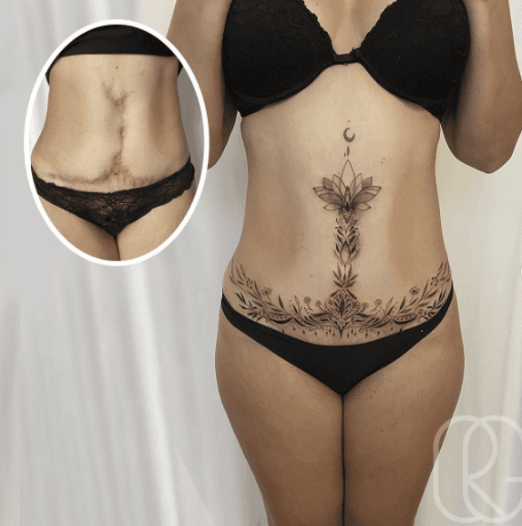 Gracias al trabajo que comparte en redes sociales, continúa llegando gente que busca cambiar su vida con el arte de Raquel. 
<br>
<br>Por ejemplo, Eliane, de 45 años, llegó con una cicatriz en su abdomen y vientre; ahora puede lucir bikinis de manera segura.