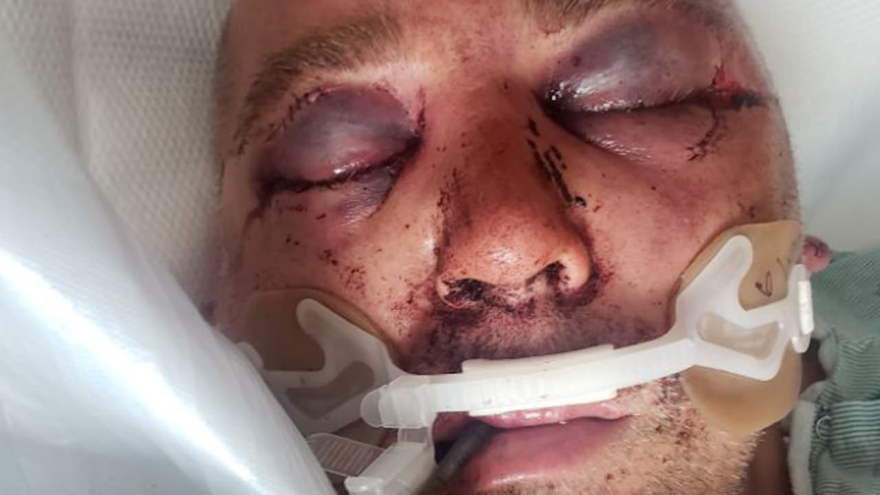 Lleva 47 días en coma tras recibir una golpiza por pedirle a su vecino que le bajara a la música