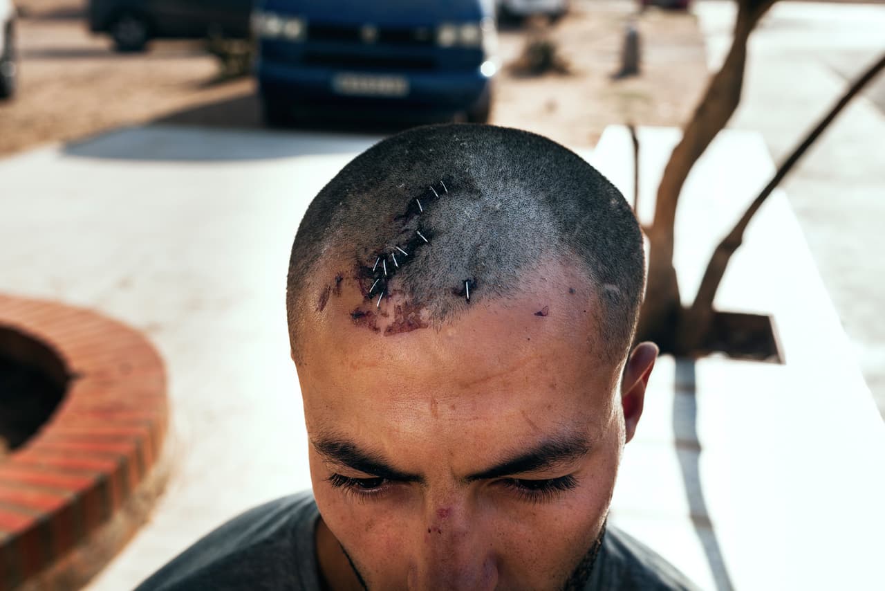 Desde la independencia de Marruecos, a mediados del siglo XX, España mantiene a Ceuta y Melilla como parte de su territorio y en los últimos años se han convertido en la frontera más problemática del norte de África. En la fotografía, un migrante argelino herido cuando intentó huir de la policía española en junio de 2018.