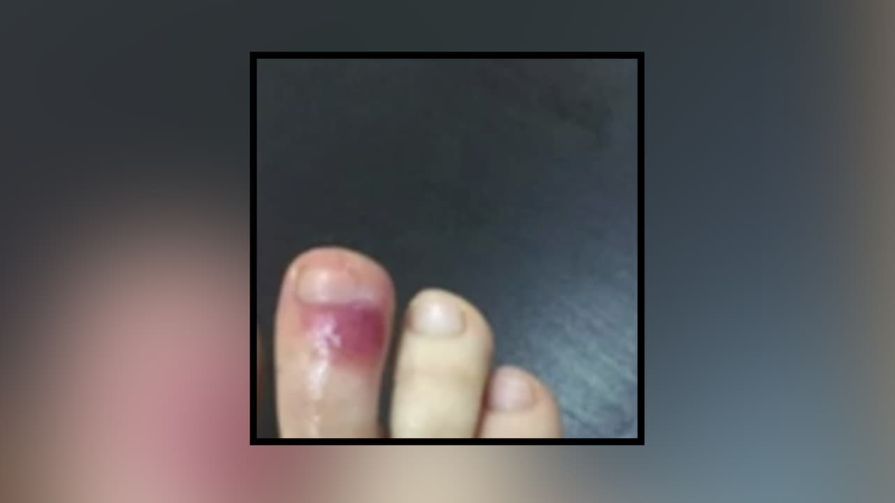 El doctor Otrosky agregó que los profesionales utilizan inmunosupresores y anticoagulantes para prevenir que el cuadro clínico avance.